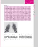 150 випадків ЕКГ=150 ECG Cases: пер. 5-го англ. вид.: Навч. посіб.. Зображення №18