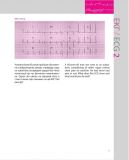 150 випадків ЕКГ=150 ECG Cases: пер. 5-го англ. вид.: Навч. посіб.. Зображення №20