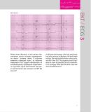 150 випадків ЕКГ=150 ECG Cases: пер. 5-го англ. вид.: Навч. посіб.. Зображення №22